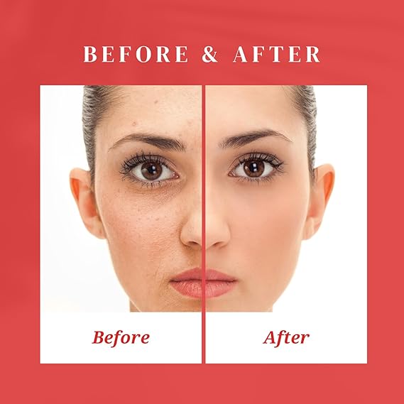 Eventone C Cream (Skin whitening & Acne Repair) Imported